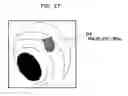 Fig. 20 - Medical image diagnosis support device and method for calculating degree of deformation from normal shapes of organ regions
