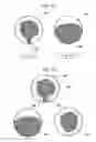 Fig. 25 - Medical image diagnosis support device and method for calculating degree of deformation from normal shapes of organ regions
