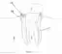 Fig. 03 - Method For Treating Periodontal Disease