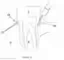 Fig. 05 - Method For Treating Periodontal Disease