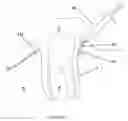 Fig. 06 - Method For Treating Periodontal Disease