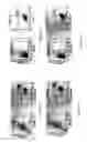 Fig. 10 - INDUCTION OF APOPTOSIS OF MALIGNANT CELLS BY ACTIVATION OF CALCIUM-ACTIVATED POTASSIUM CHANNELS