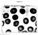 Fig. 11 - Nanofluidized B-12 composition and process for treating pernicious anemia
