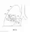 Fig. 03 - METHODS AND DEVICES FOR MAINTAINING SURGICALLY CREATED CHANNELS IN A BODY ORGAN