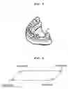 Fig. 03 - Stent for guiding the location/direction of implant, and production method thereof