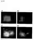 Fig. 32 - Method of diagnosing colon and gastric cancers