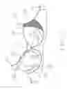 Fig. 03 - Mastectomy bras