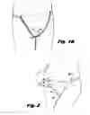 Fig. 03 - Adjustable undergarment