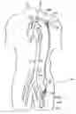 Fig. 01 - Implantable heart assist system and method of applying same