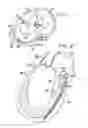 Fig. 02 - System, including method and apparatus for percutaneous endovascular treatment of functional mitral valve insufficiency
