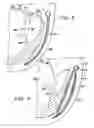 Fig. 03 - System, including method and apparatus for percutaneous endovascular treatment of functional mitral valve insufficiency