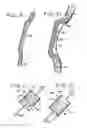 Fig. 05 - System, including method and apparatus for percutaneous endovascular treatment of functional mitral valve insufficiency