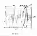 Fig. 06 - Ischemia detection using a heart sound sensor
