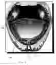 Fig. 06 - Oral device