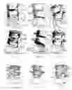 Fig. 02 - Customizing an intervertebral implant