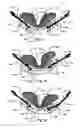 Fig. 10 - Brace for the proximal tibiofibular joint