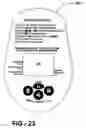 Fig. 20 - Infusion assembly that simultaneously delivers therapeutic fluid to plural body sites