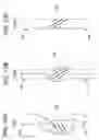 Fig. 08 - Vertebral facet stabilizer