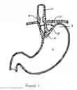 Fig. 02 - Methods and devices for endosonography-guided fundoplexy