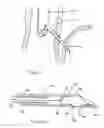 Fig. 03 - Methods and devices for endosonography-guided fundoplexy