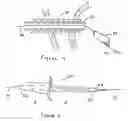 Fig. 04 - Methods and devices for endosonography-guided fundoplexy