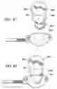 Fig. 35 - Adjustable vacuum chamber for a surgical suturing apparatus