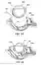 Fig. 34 - Surgical suturing apparatus with needle position indicator