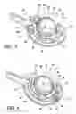 Fig. 05 - Surgical suturing apparatus with anti-backup system