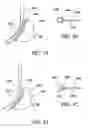 Fig. 32 - Surgical suturing apparatus with anti-backup system