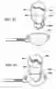 Fig. 35 - Surgical suturing apparatus with anti-backup system
