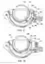 Fig. 09 - Quick load mechanism for a surgical suturing apparatus