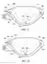 Fig. 11 - Quick load mechanism for a surgical suturing apparatus