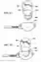 Fig. 35 - Quick load mechanism for a surgical suturing apparatus