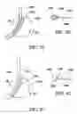 Fig. 32 - Method for suture lacing