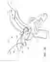 Fig. 05 - Method and apparatus for holding suture ends to facilitate tying of knots