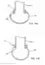 Fig. 07 - Devices and methods for forming magnetic anastomoses between vessels