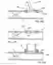 Fig. 16 - Devices and methods for forming magnetic anastomoses between vessels