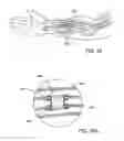 Fig. 19 - Devices and methods for forming magnetic anastomoses between vessels