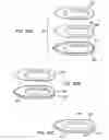 Fig. 20 - Devices and methods for forming magnetic anastomoses between vessels