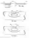 Fig. 53 - Devices and methods for forming magnetic anastomoses between vessels