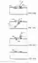 Fig. 60 - Devices and methods for forming magnetic anastomoses between vessels