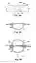 Fig. 75 - Devices and methods for forming magnetic anastomoses between vessels