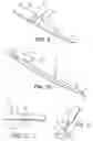 Fig. 05 - Intragastric device for treating obesity