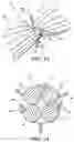 Fig. 06 - Intragastric device for treating obesity