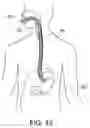 Fig. 23 - Intragastric device for treating obesity