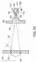 Fig. 40 - Intragastric device for treating obesity