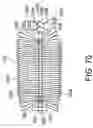 Fig. 41 - Intragastric device for treating obesity