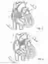 Fig. 03 - Apparatus and method for cardioversion