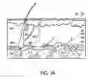 Fig. 02 - Radiation separating shield for skin treatment
