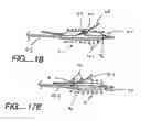 Fig. 11 - Bifurcation stent delivery catheter assembly and method